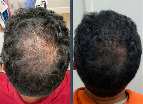 The Best Exosome Treatment Near Me