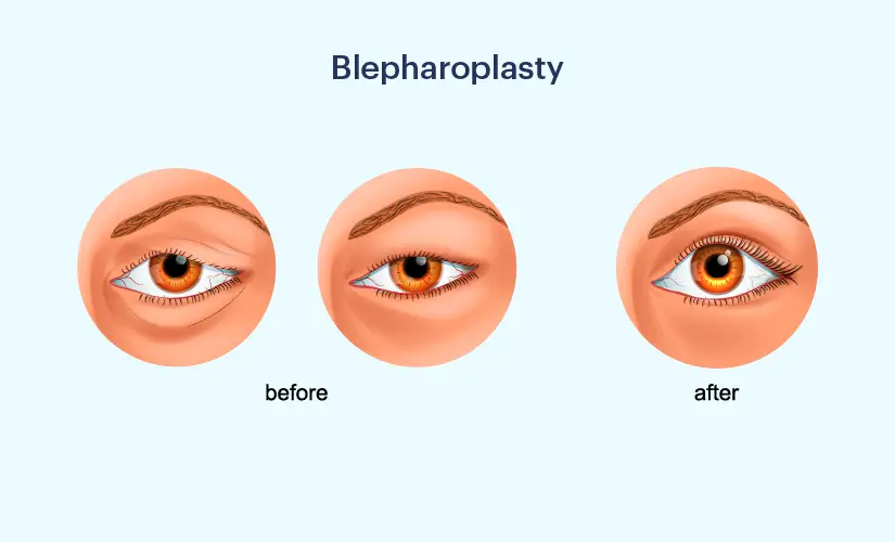  Best Blepharoplasty in mira road & borivali