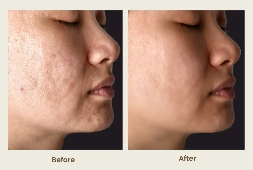 Best Exosome Therapy Mira Road & Borivali