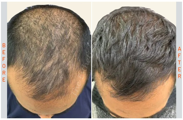 Exosome Hair Growth Treatment Borivali & Mira road 
