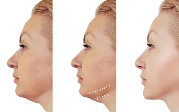 Chin Implants Mira Road and borivali 