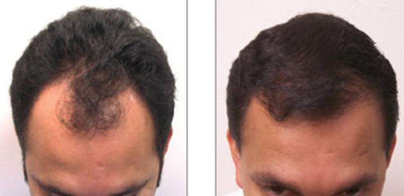 Best Hair Transplant Clinic in Borivali & Mira road  