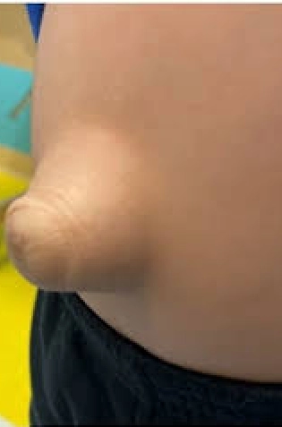 Best Hernias Treatment In Mira road Borivali