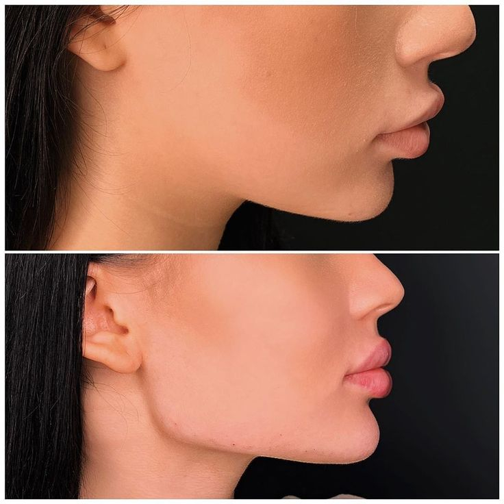 Cheek Implants Mira Road, & Borivali