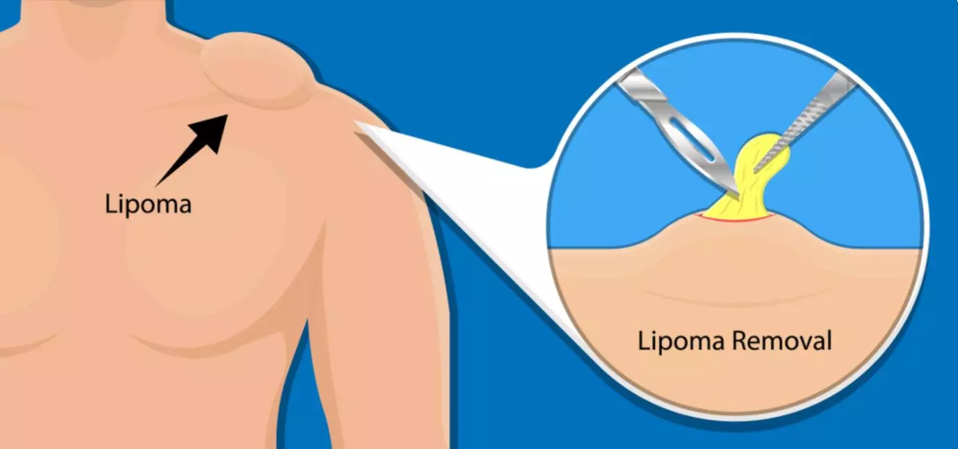 Understanding Lipomas: Causes, Symptoms & Treatment Options in Mumbai