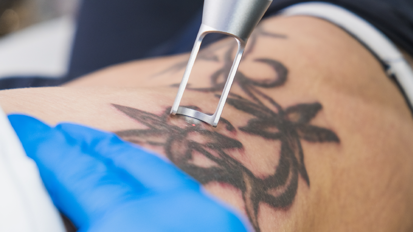 Best Laser Tattoo Removal Borivali & Mira road 