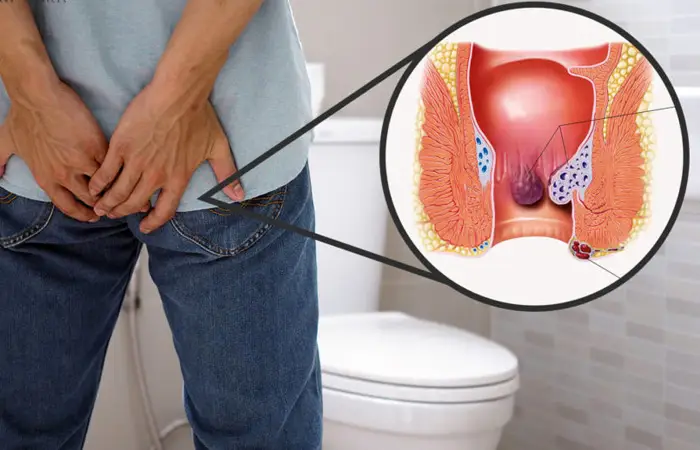 Best Piles Treatment In m ira road & Borivali 