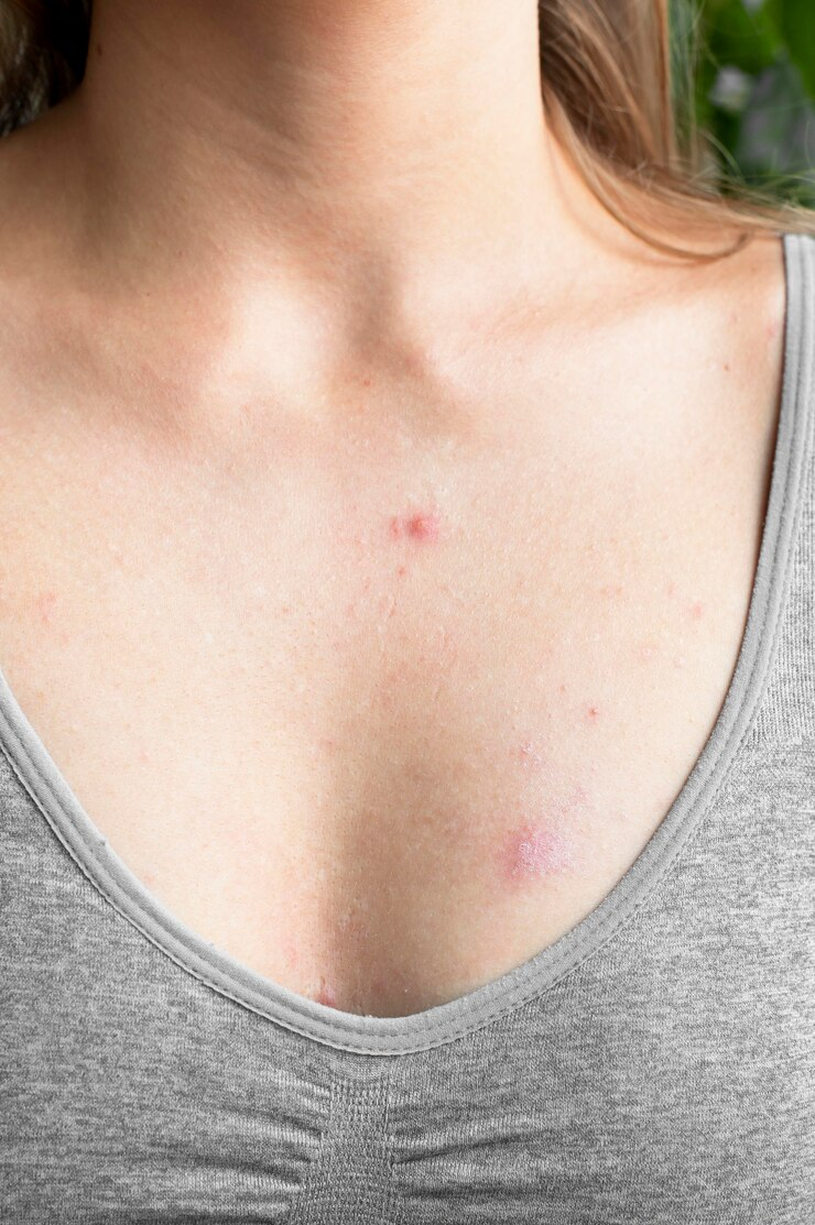 Best Chickenpox scars treatment in miraroad & borivali