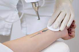 Laser Tattoo Removal  IN MIRA ROAD , BORIVALI , ANDHERI 