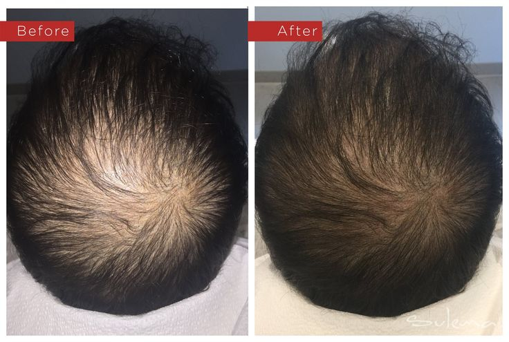 Best Hair GFC Clinic Mira Road & borivali  